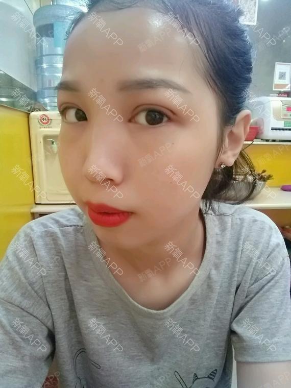 双眼皮几天拆线最好_双眼皮拆线好天天拆吗_双眼皮拆线好天天换药吗