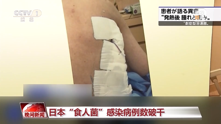 容易被误诊为感冒，日本“食人菌”感染破千！发病到休克最快只需24小时