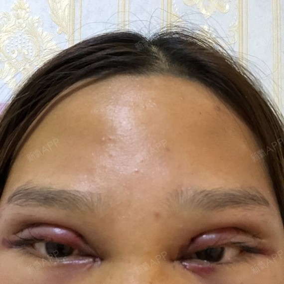 双眼皮几天拆线最好_双眼皮拆线好天天拆吗_双眼皮拆线好天天换药吗