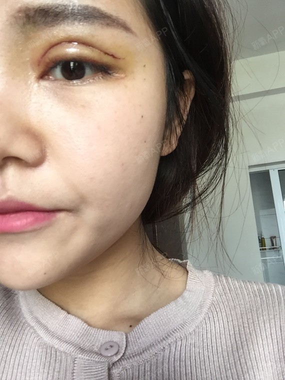 双眼皮拆线好天天拆吗_双眼皮拆线好天天换药吗_双眼皮几天拆线最好