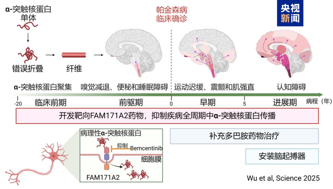 全球首次！关于帕金森，我国团队发布突破性成果