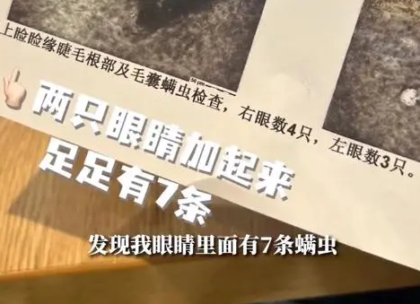 女子爱吸猫狗，把脸埋毛里致眼睛长7条螨虫