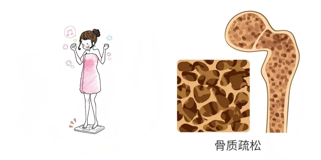 骨质疏松症早了解,别等骨折才重视|世界骨质疏松日 骨质疏松症早了解,别等骨折才重视|世界骨质疏松日