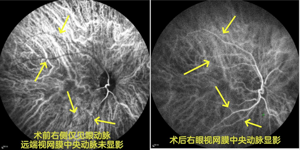 八旬老伯轻信短视频停服降压降糖药 突发“眼中风”致右眼失明 八旬老伯轻信短视频停服降压降糖药 突发“眼中风”致右眼失明