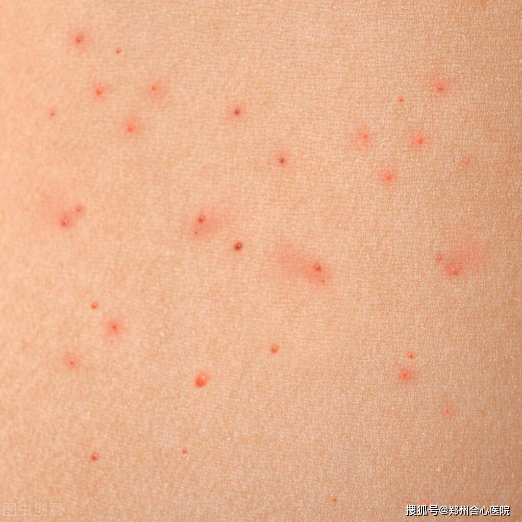 hpv初期小红点照片.jpg