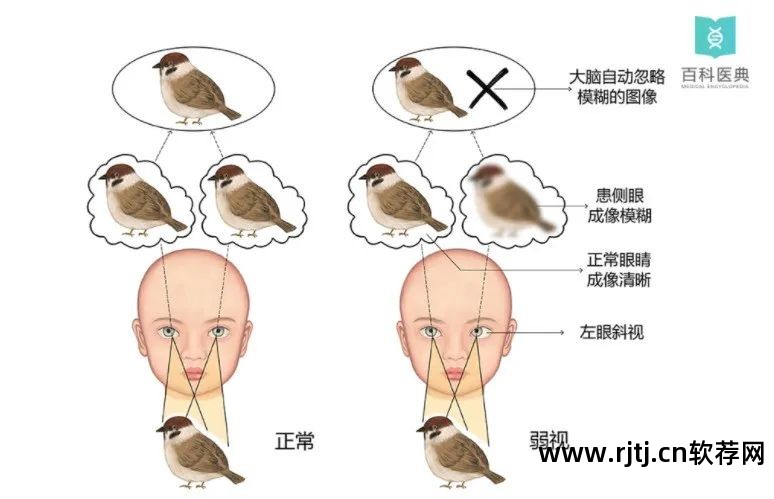 治疗软件弱视有哪些_弱视治疗软件下载_治疗弱视的软件